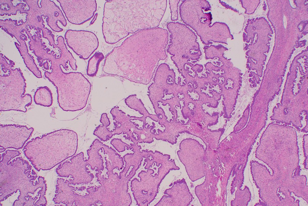 RawiaMo57385655's tweet image. Ovary 

#gynpath #pathfamily #PathTwitter #pathology @Grilli15 @GeronimoJrLapac @FelipePatologia