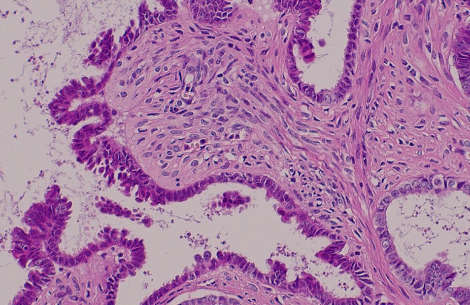 RawiaMo57385655's tweet image. Ovary 

#gynpath #pathfamily #PathTwitter #pathology @Grilli15 @GeronimoJrLapac @FelipePatologia