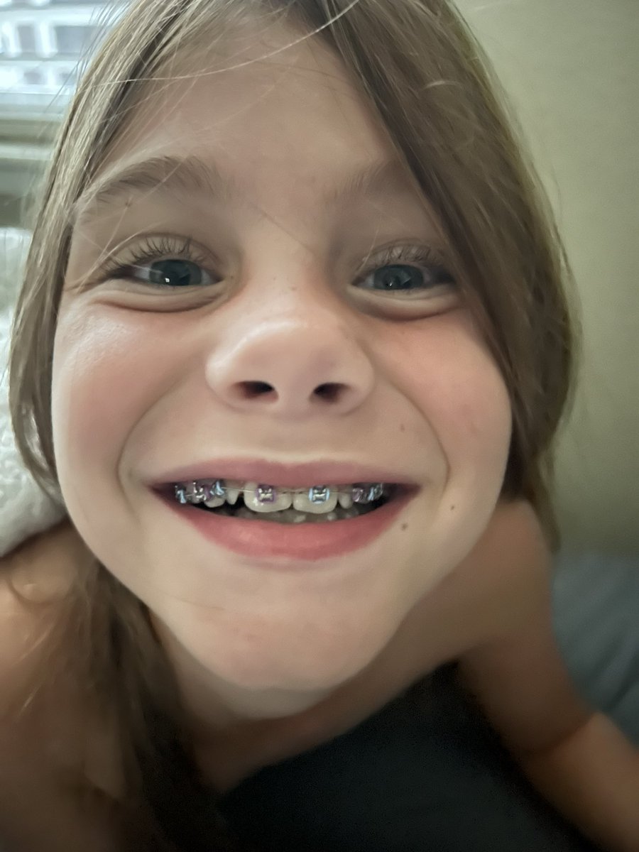 SFGiantsChica's tweet photo. Before braces and about 16 hours after braces. Gap is GONE 😱 #KateRenee https://t.co/QVRyJBAsJF