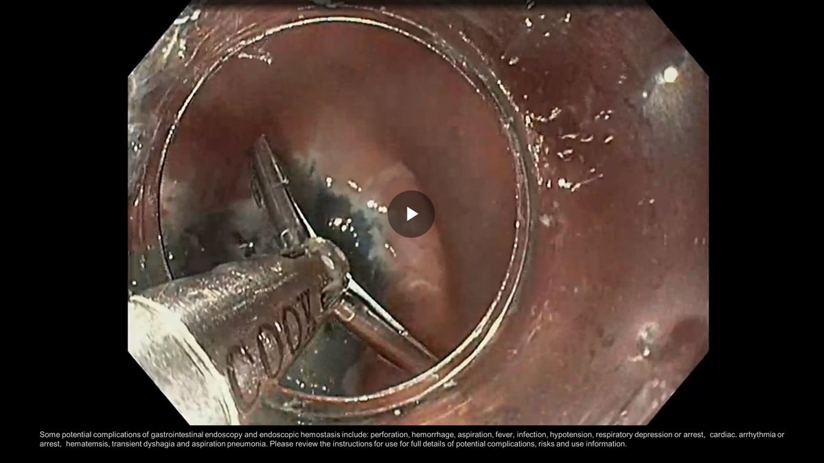 Watch Dr. Irving Waxman of Rush University use Cook’s new Instinct Plus endoscopic clip for closure post-ESD. Click here for the video: bit.ly/3Seh2tl  
 
#GItwitter #some4endoscopy #ESD #endoscopy <a href="/RushMedical/">Rush University System for Health</a> <a href="/I_Waxman_AHC/">Dr. Irving Waxman</a>
 
Product IFU - bit.ly/3rc172O