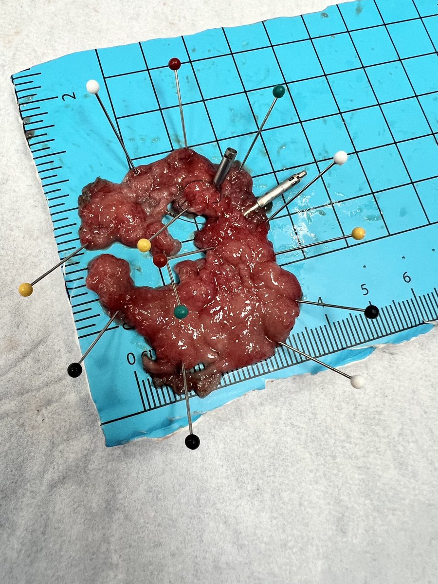 Great educational lecture form the #scopingsundays #MedEd initiative on ESD! Relevant to below: >270 degree resection with utilization of that device See another post of mine for example of “traction in action” with the device. #Endoscopy #GITwitter #Wireisback