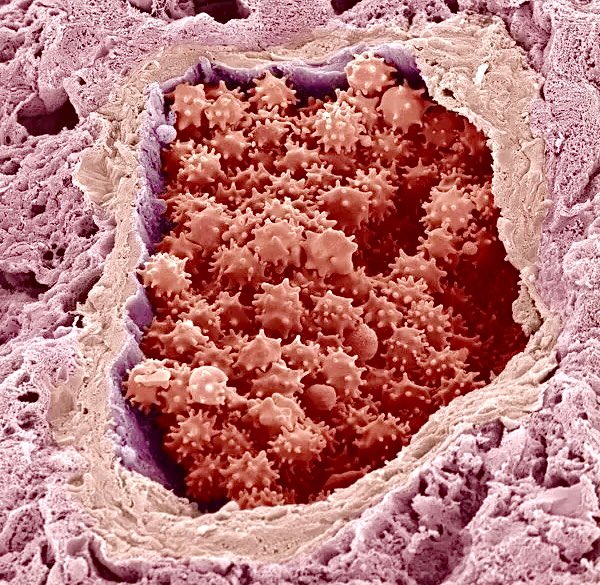 microscopic-images-on-twitter-crenated-red-blood-cells-in-a-blood