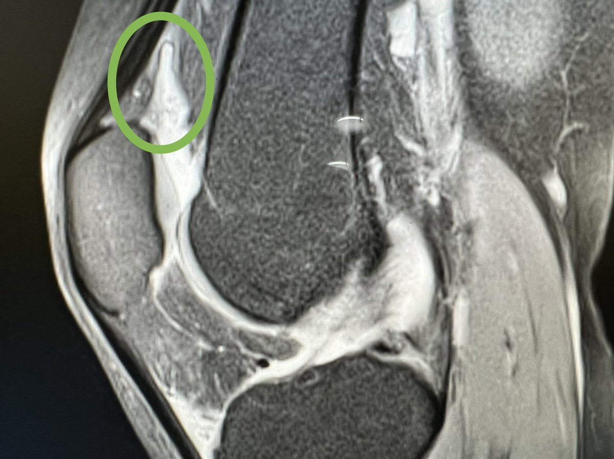 Useful to look closely at the synovium of the suprapatella pouch when scanning a patient with a knee effusion. Thickened synovium often becomes clear against the black contrast of the fluid. Perhaps more sensitive than MRI?

This patient has seronegative inflammatory arthropathy.