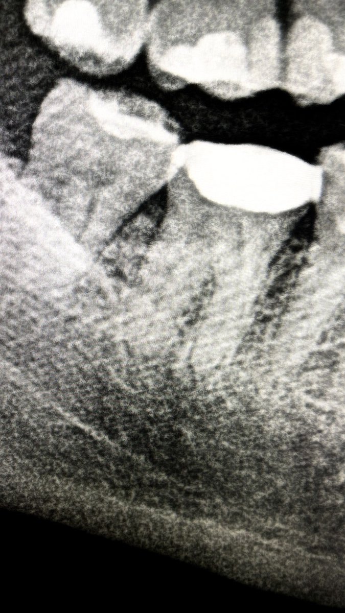 drpmdfuentes's tweet photo. #pieza37 #necrotica con #endocorona #endodoncia con #limas #protaperultimate #activacion del irrigante con #endoactivator y #obturacion con #gutaperchatermoplástica con #calamusdual 🦷 Siempre #trabajando en lo #mejor para el #paciente y con las #mejores #tecnologías 😉😎 https://t.co/ne0SMMw43U