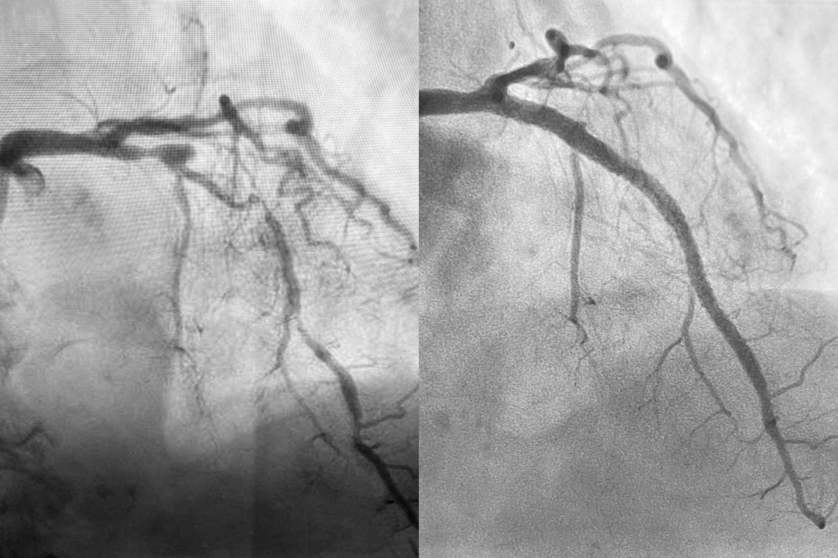 Shockwave Medical tweet media