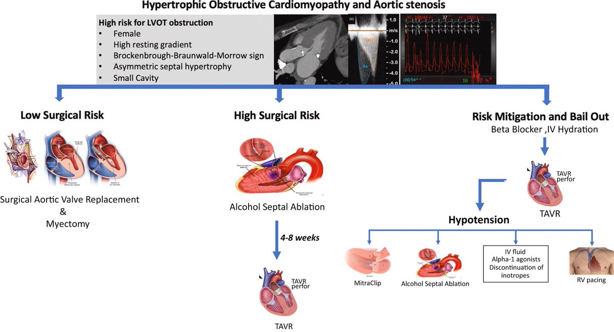 Giorgio A. Medranda MD, FACC, FAHA, FSCAI (@giorgiomedranda) on Twitter photo Just Accepted in <a href="/JACCJournals/">JACC Journals</a>!
A Word of Caution Before Treating #AorticStenosis in Patients With Concomitant #LVOT Obstruction by <a href="/DorBen/">Itsik Ben Dor</a> <a href="/BCase07/">BCaseMD</a> <a href="/gabyweissman/">Gaby Weissman</a> <a href="/ron_waksman/">Ron Waksman</a> et al.
#JACCCaseReports #CRT #HCM #TAVR
<a href="/ACCinTouch/">American College of Cardiology</a> <a href="/CRT_meeting/">CRT Meeting</a>
jacc.org/doi/full/10.10… Just Accepted in <a href="/JACCJournals/">JACC Journals</a>!
A Word of Caution Before Treating #AorticStenosis in Patients With Concomitant #LVOT Obstruction by <a href="/DorBen/">Itsik Ben Dor</a> <a href="/BCase07/">BCaseMD</a> <a href="/gabyweissman/">Gaby Weissman</a> <a href="/ron_waksman/">Ron Waksman</a> et al.
#JACCCaseReports #CRT #HCM #TAVR
<a href="/ACCinTouch/">American College of Cardiology</a> <a href="/CRT_meeting/">CRT Meeting</a>
jacc.org/doi/full/10.10…