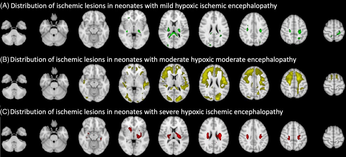 SamPayabvash's tweet photo. Voxel-wise assessment of #Brain injury patterns in hypoxic ischemic encephalopathy of term #neonates by @pratheek_bobba our @YaleMed SM-3 in collaboration with @AjayMalhotraRad @sheth_kevin @sarahntaylorneo @YaleRadiology @NeurologyYale @YalePediatrics  https://t.co/dxDlrAO5j8 https://t.co/m9hVgqFAiN