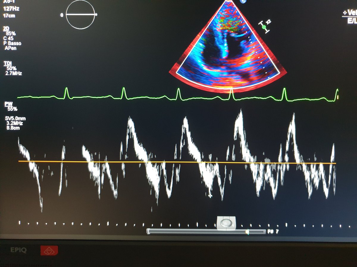 19 yo female🙎🏻‍♀️, athlete🏃🏻‍♀️, hystory of palpitations.
TTE: dilated LV,  normal LVEF, bileaflet MVP (Pickelhaube sign) with Barlow disease with mitral annular disgiunction with moderate mitral rigurgitation.
<a href="/ElisabettaBex/">Elisabetta Tonet</a>
<a href="/venturoli_elisa/">Elisa Venturoli</a>