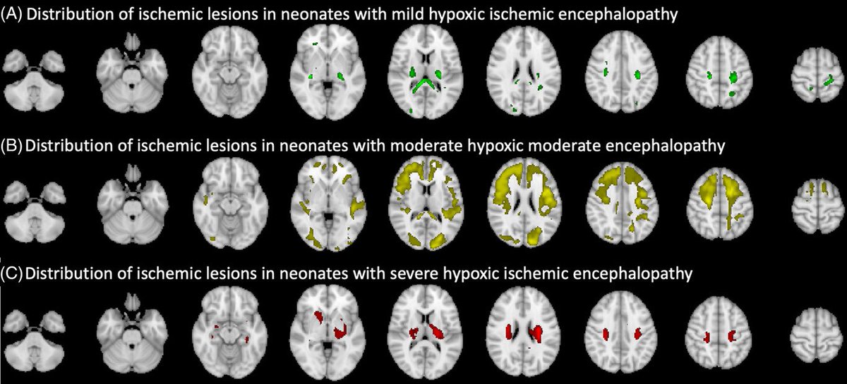 pratheek_bobba's tweet photo. Excited to share my second publication with @SamPayabvash in which we explored brain injury patterns in neonates with hypoxic ischemic encephalopathy! https://t.co/yzGVZsZweJ @sarahntaylorneo @AjayMalhotraRad @sheth_kevin @YaleRadiology @YalePediatrics @NeurologyYale https://t.co/AuP7koyoPv