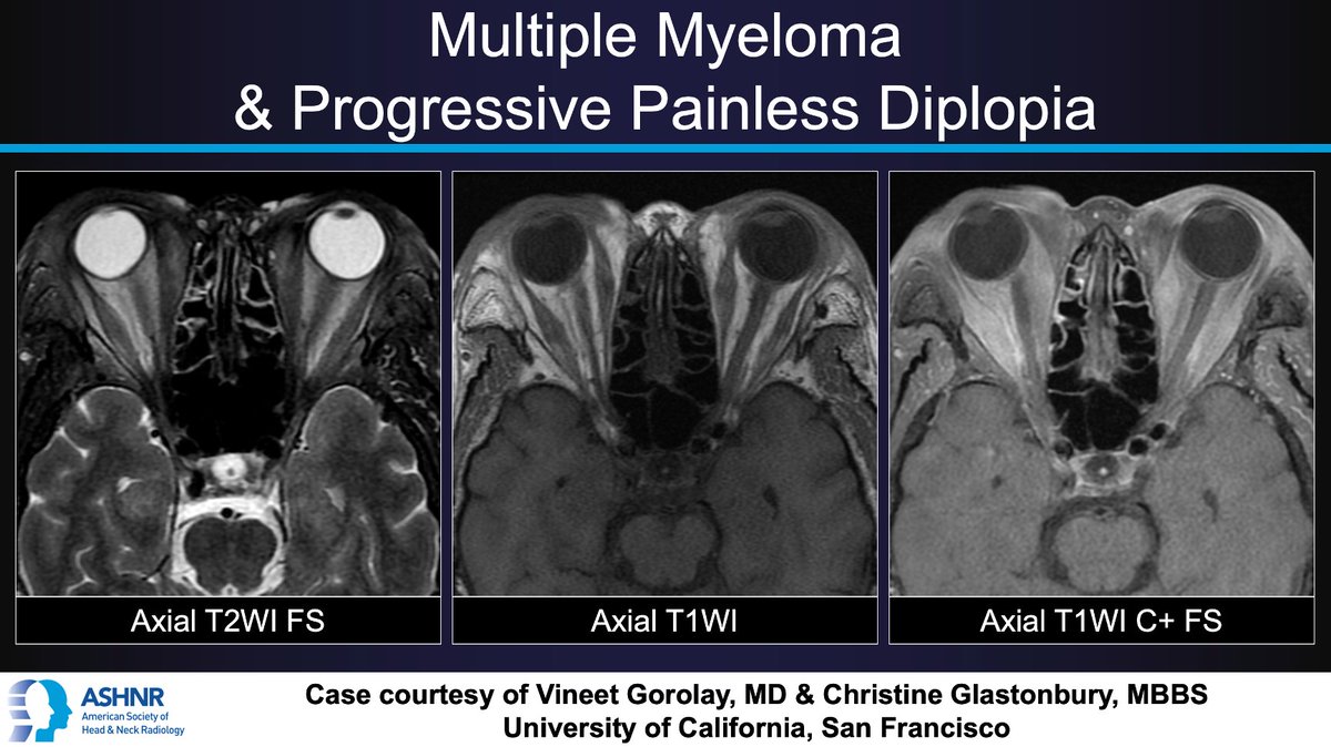 #ASHNRCOTW #203: Multiple myeloma & progressive painless diplopia. Dx? Thx Drs. Gorolay & @CMGlastonbury 4 case! #ASHNR23 Answer w/ appropriate GIF only -- stay professional & don't spoil it! @callyrobs @DShatzkes @CDP_Rad @rhwiggins @nakoontz @cmtomblinson @ESHNRSociety