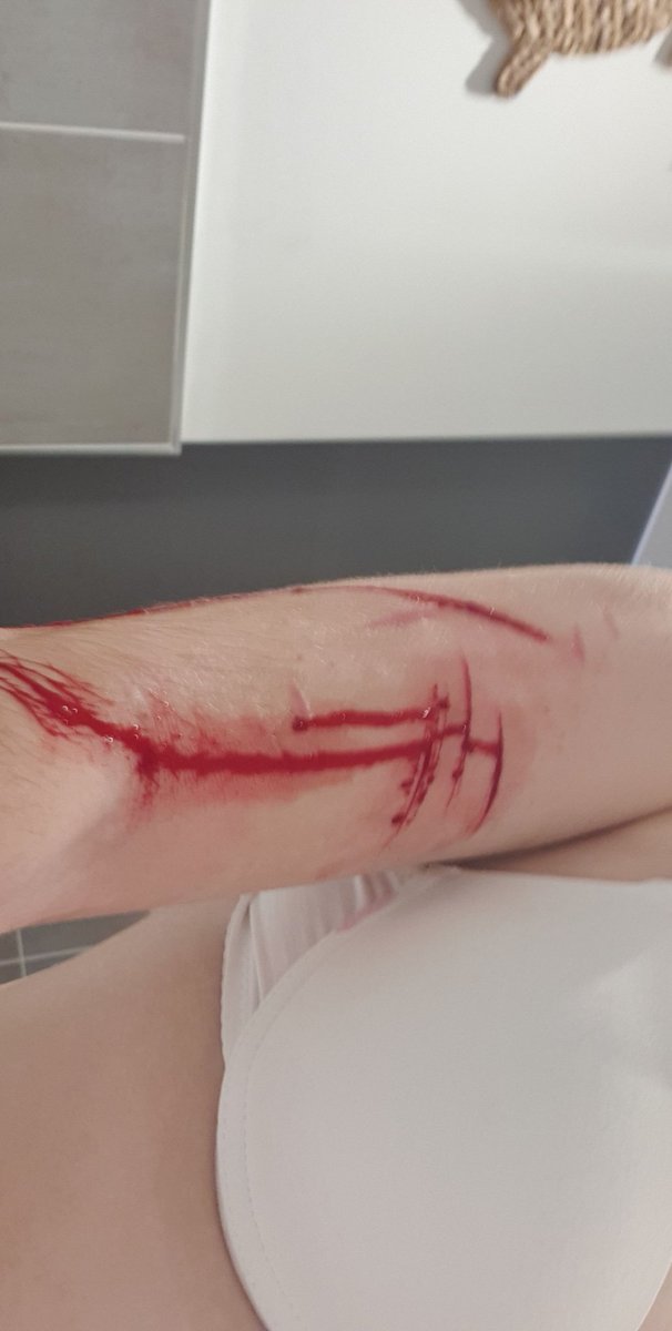 proshtwt's tweet photo. FAKE SFS!!!

These are feom last week to a month ago. Imma do it again soon and it will be better. It has to be #TWT #shtwt #scarstwt #catscratchestwt #madeofbeanstwt #beanstalk https://t.co/D3nZSSGGL9