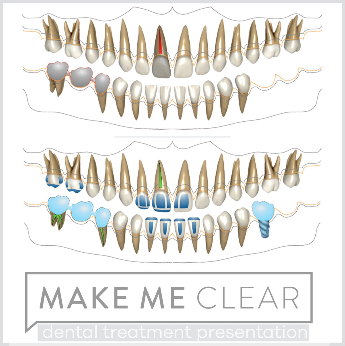 makemeclearapp's tweet photo. https://t.co/GTFH40K8LC

•
•
•
•
•

#treatmentplanning #dentistry #dentalsoftware #treatmentplanpresentation #planpresentation #communicationindentistry #interdisciplinarydentistry
#dentalmarketing https://t.co/CyW0K4rv0V
