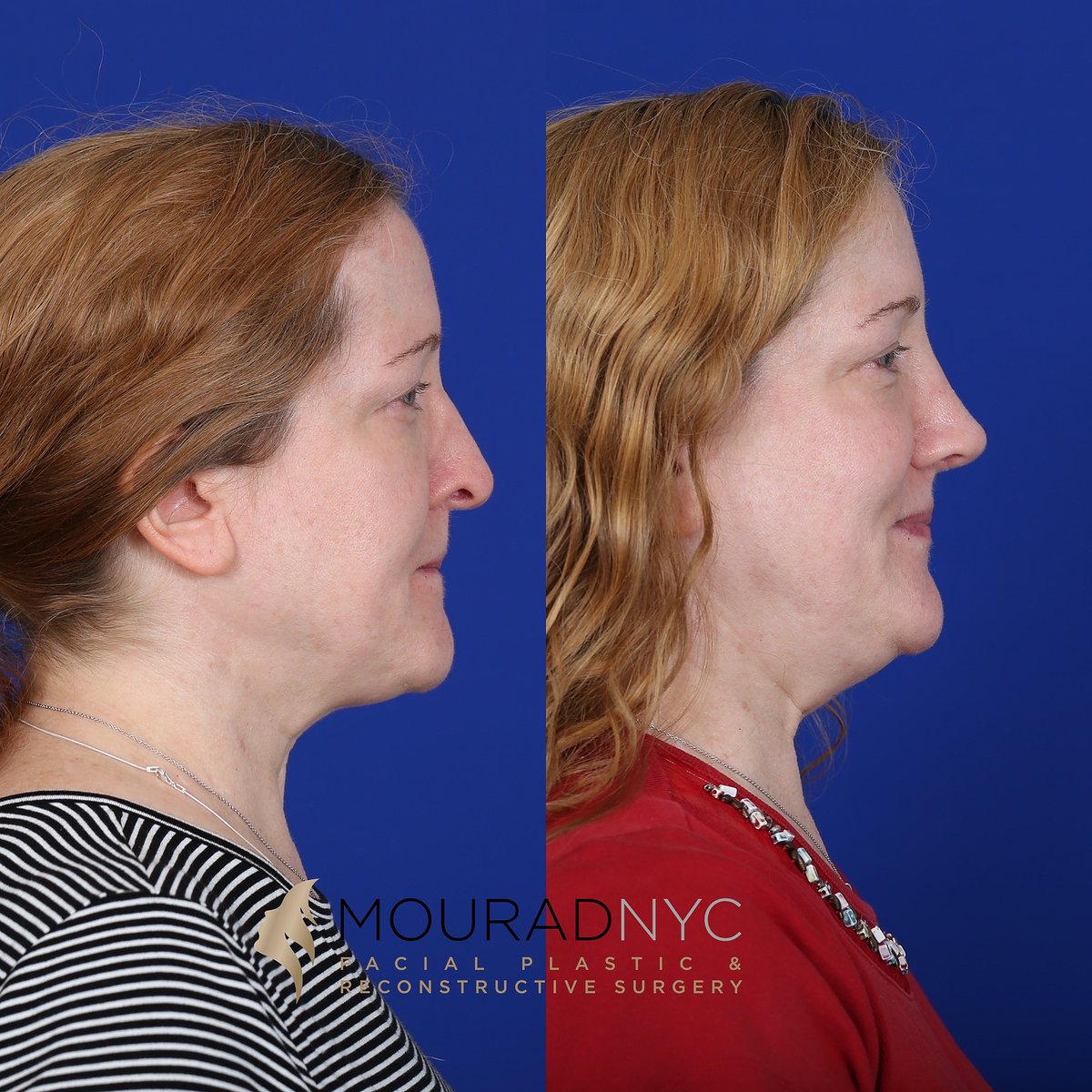 NYCFaceDoc's tweet photo. Fortunate to share this wonderful patient's transformation photos after a rhinoplasty 3 months ago! https://t.co/ymIwEl7ybz
