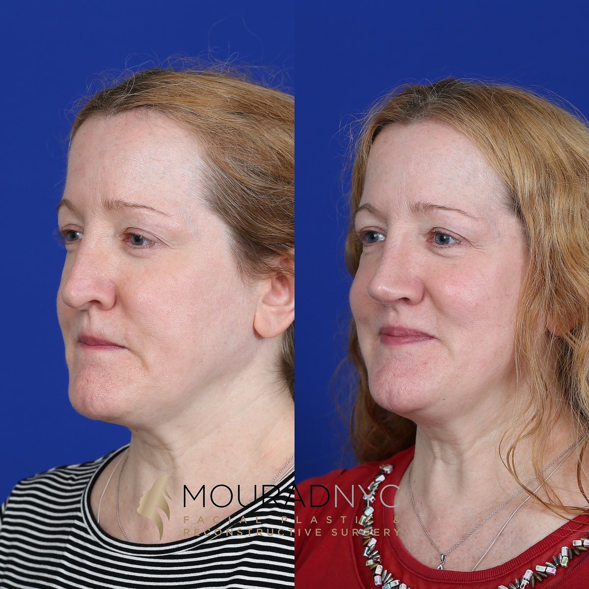 NYCFaceDoc's tweet photo. Fortunate to share this wonderful patient's transformation photos after a rhinoplasty 3 months ago! https://t.co/ymIwEl7ybz