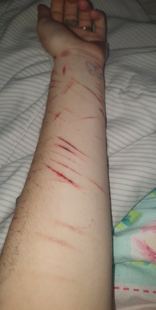 proshtwt's tweet photo. FAKE SFS MAKEUP!!!

I really wish I could go deeper. I have older ones that are deep but they still heal so quickly :/ #shtwt #madeofbeanstwt #rasberryfillingtwt #scratchtwt https://t.co/uvI9TctLCB