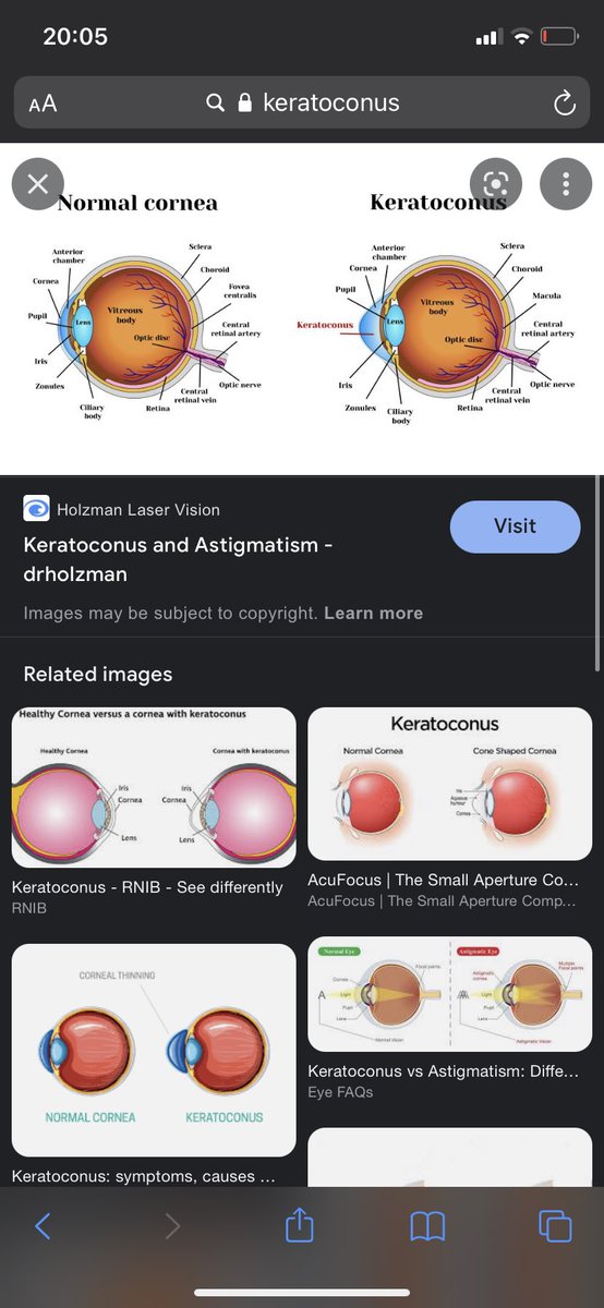 8ihi9's tweet photo. Learnt something new, constant rubbing of the eyes and the poor removal of contact lenses can cause a weakened cornea . This can cause an eye condition called Keratoconus which is degenerative and causes you see blurred vision both near and far ( even with strong prescription ) https://t.co/EXeYaMpBPS