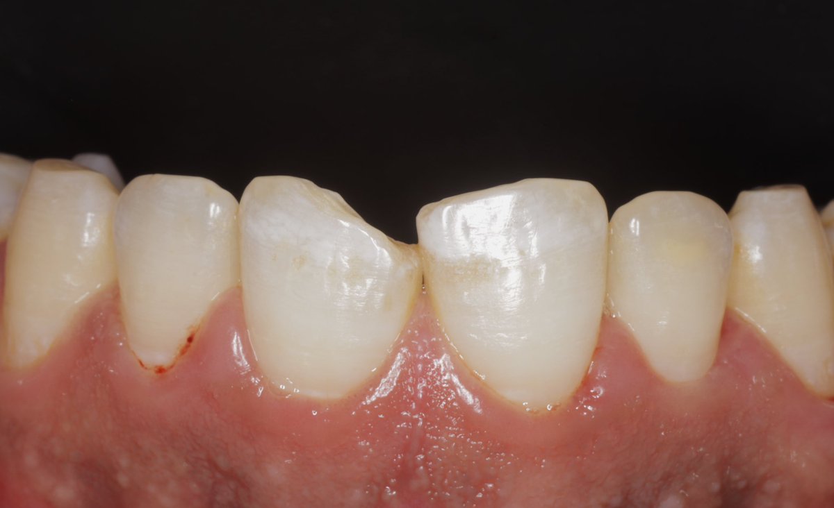 a_sa_dent's tweet photo. Direct composite restoration 
حشوة تجميلية 
#kku
#kku_dent 
#Restoration 
#rubber_dam

https://t.co/IrHkJLRQwM https://t.co/23df99DJ0g