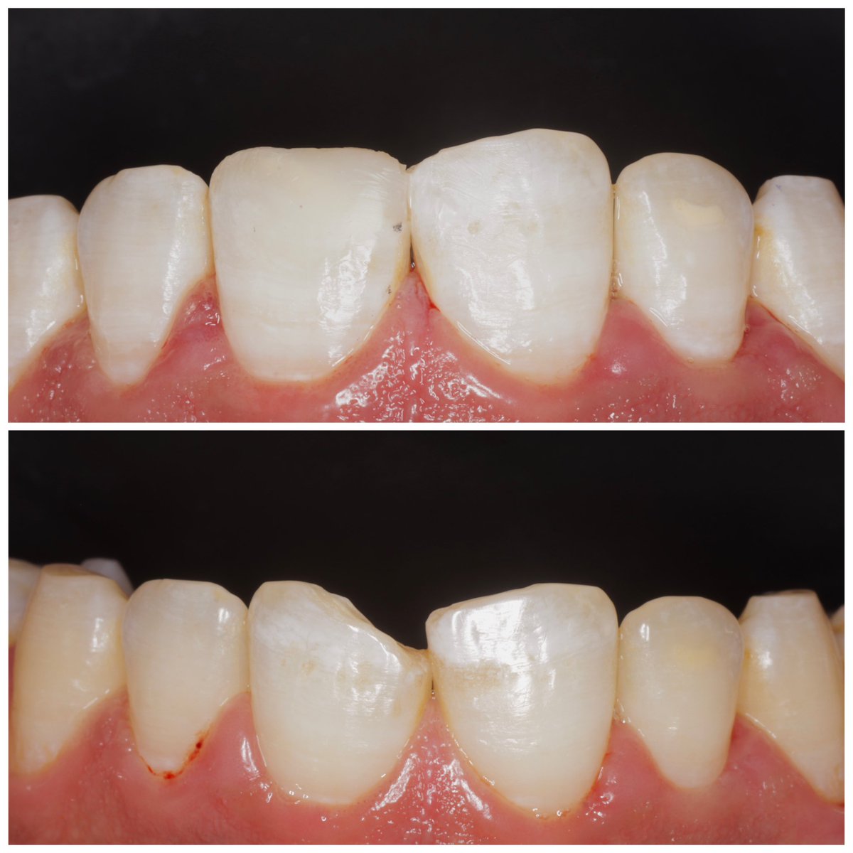 a_sa_dent's tweet photo. Direct composite restoration 
حشوة تجميلية 
#kku
#kku_dent 
#Restoration 
#rubber_dam

https://t.co/IrHkJLRQwM https://t.co/23df99DJ0g