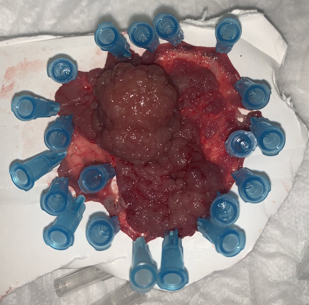AntoineDebourd1's tweet photo. Another day in endoscopy @CHU_Montpellier . 60x60mm sigmoid lesion in 1h30.
Love the multiple traction. Efficient and quick ! #ESD #MiniInvasive https://t.co/KsQWaIZFgI