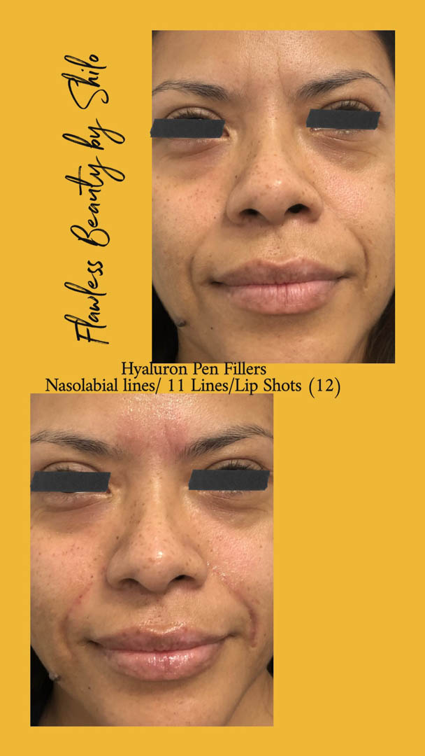 Reach out to us if you're in the San Diego area and are in need of Hyaluron Pen Filler services. Flawless Beauty By Shilo is looking forward to assisting you! #HyaluronPenFiller bit.ly/3Q9DrWK