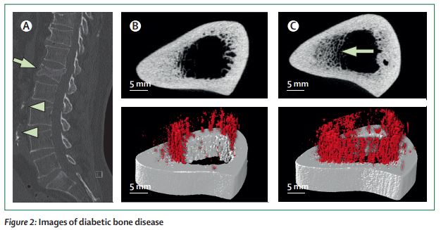 TheLancetEndo's tweet photo. #Bone fragility in #diabetes: novel concepts and clinical implications https://t.co/NpOYc1bLWc #T1D #T2D #BoneFragility #osteoporosis #fractures #BMD https://t.co/hrIWwFQWXB