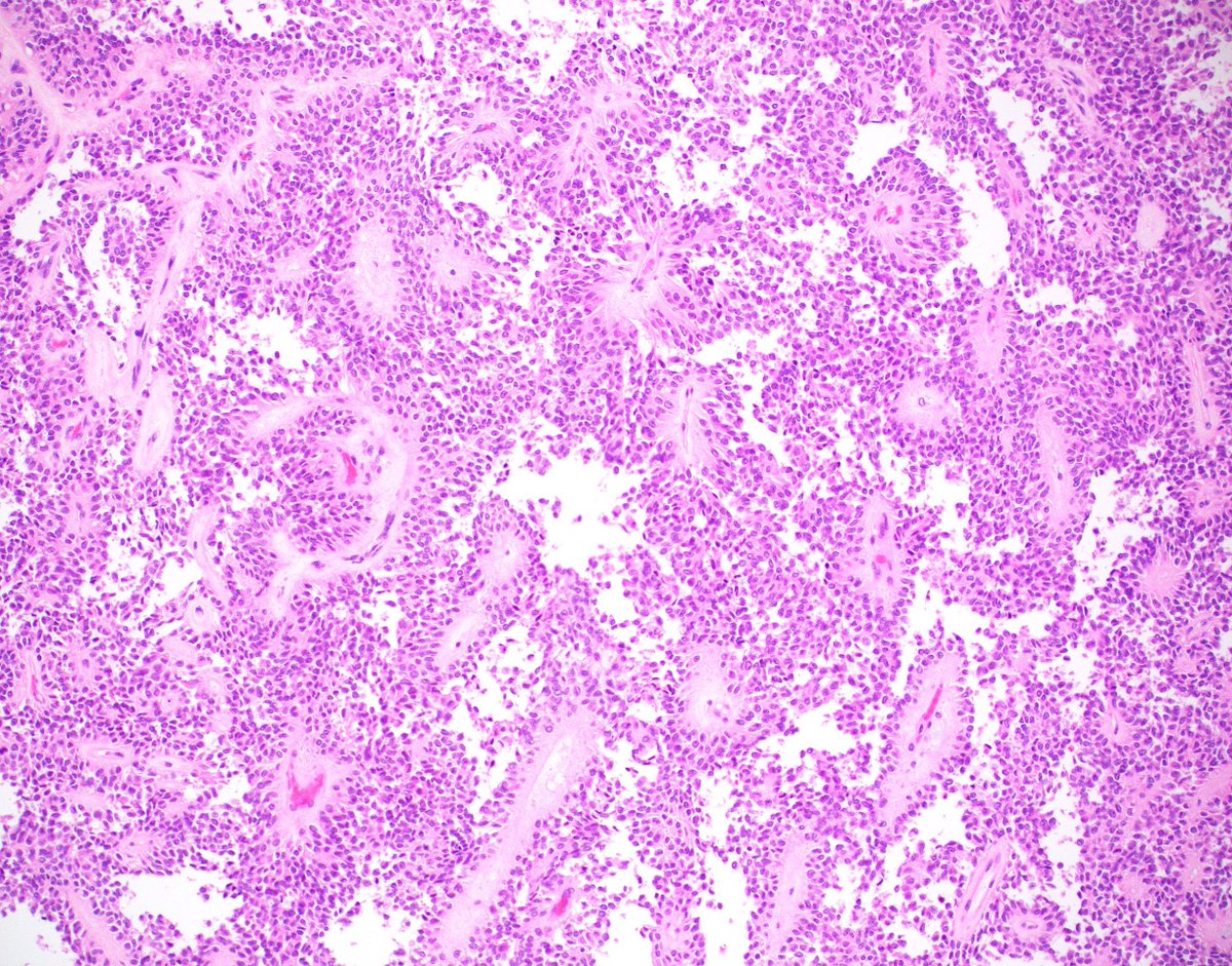 The new #CaseoftheQuarter is now live!
Case 2: Quarter 3, 2022 
Answer the poll question👇 followed by case discussion
pbpath.org/case-2-quarter…
Case contributed by:
Elizabeth Thompson, MD, PhD
Huili Li, MD