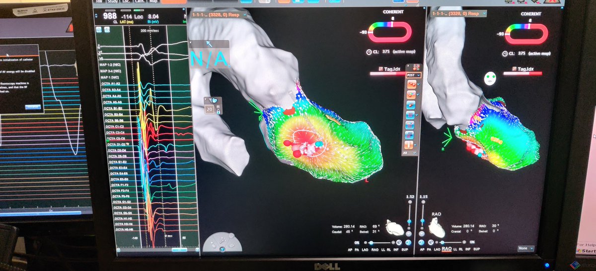 mattiastraz's tweet photo. Today's another successful #VT ablation with the new OCTARAY mapping catheter with TRUEref Technology
#biosense #EPlab https://t.co/tGQIYO8T6t