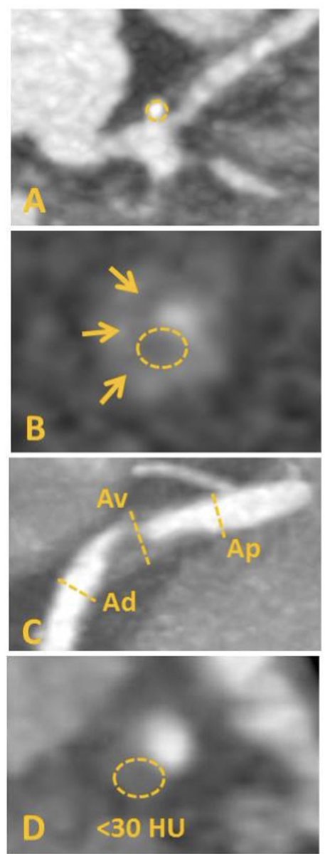 Nuevo CAD-RADS 2.0 2022. Cada vez mas importante la carga de placa, la perfusión miocárdica y el FFRct. TAC espectral ayuda a un diagnóstico más preciso #yessct journalofcardiovascularct.com/action/showPdf…