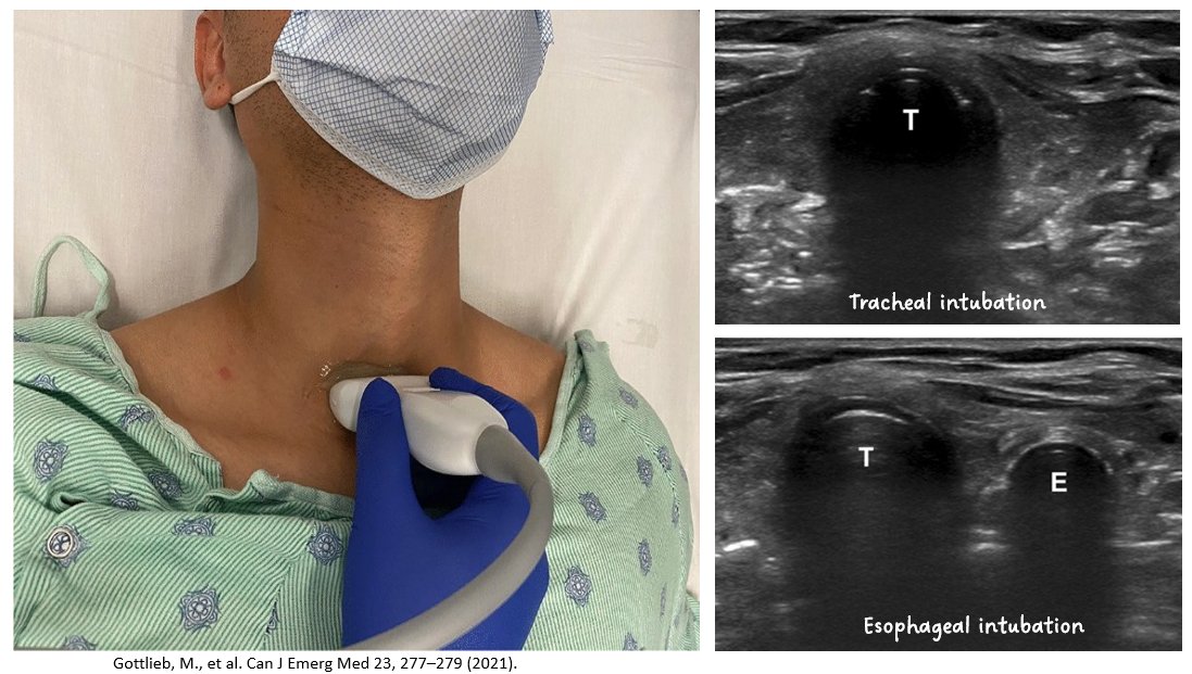 NephroP's tweet photo. #POCUS for intubation confirmation.
🔗https://t.co/DYdCgZEuvD
#MedEd #CriticalCare https://t.co/ZMkpDv7iR4