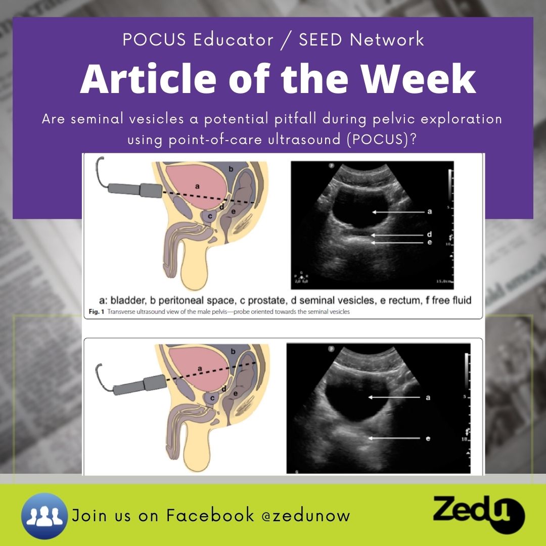 zedunow's tweet photo. Article of the week
🍆Seminal vesicles as free fluid false➕in FAST?
👉YES
🪧Soln: emphasise dynamic assessment, fanning & long view
Have you encountered this false➕? How would you use this in a teaching moment?
https://t.co/aYQCuvoMmK
#POCUS #USSEED #SEED #POCUS #MedTwitter https://t.co/TkUxllmbtw
