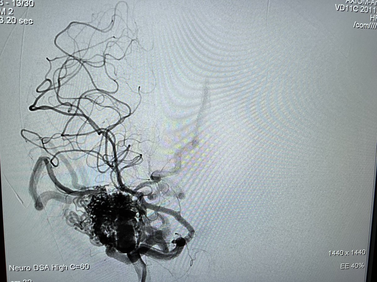 Johanna T. Fifi, MD (@johannatfifi) on Twitter photo 1 week into <a href="/SiemensHealth/">Siemens Healthineers</a> #Icono and the awesome #neuroIR TEAM at Mount Sinai West <a href="/MountSinaiCVC/">Mount Sinai Cerebrovascular</a> <a href="/MountSinaiNeuro/">Mount Sinai Neurosurgery</a> has this machine ready for its full potential. <a href="/TShigematsuMD/">Tomo Shigematsu</a> <a href="/rdeleacymd/">Reade De Leacy MD</a> <a href="/hali_tab/">Halima Tabani</a> <a href="/THardiganMDPhD/">Trevor Hardigan</a> 1 week into <a href="/SiemensHealth/">Siemens Healthineers</a> #Icono and the awesome #neuroIR TEAM at Mount Sinai West <a href="/MountSinaiCVC/">Mount Sinai Cerebrovascular</a> <a href="/MountSinaiNeuro/">Mount Sinai Neurosurgery</a> has this machine ready for its full potential. <a href="/TShigematsuMD/">Tomo Shigematsu</a> <a href="/rdeleacymd/">Reade De Leacy MD</a> <a href="/hali_tab/">Halima Tabani</a> <a href="/THardiganMDPhD/">Trevor Hardigan</a>