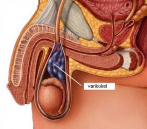 Bismillaah..
Ada yang nanya kenapa varikokel bs mengakibatkan gangguan kesuburan ?
Nah gini jawabann...
