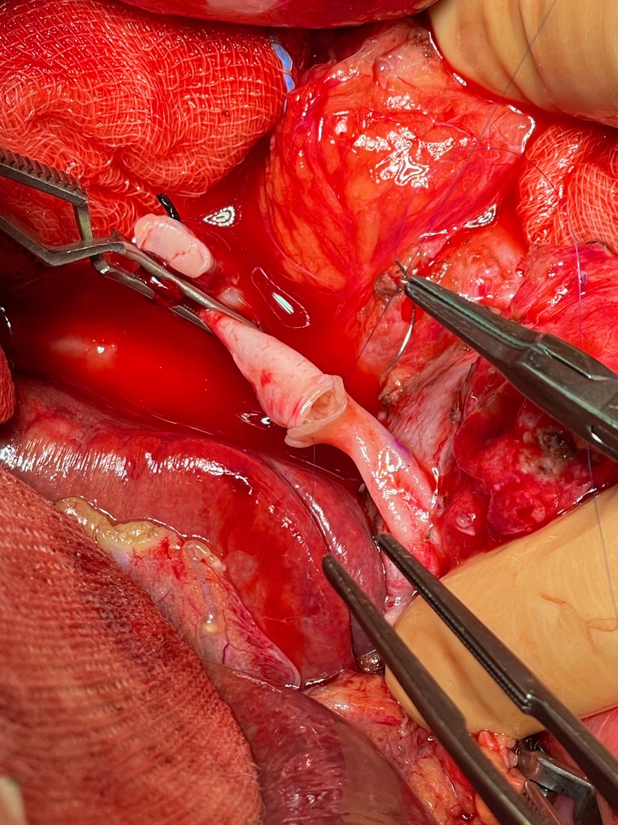 DeCarlis_R's tweet photo. Supraceliac aortic conduit in #liver #transplant @Sa92_10 @MglMichele https://t.co/YToh733ndA