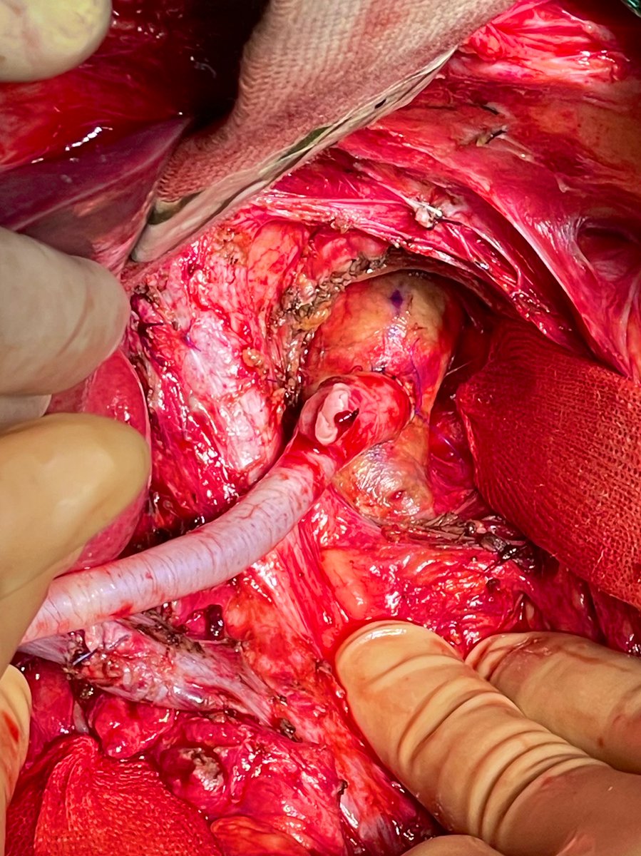 DeCarlis_R's tweet photo. Supraceliac aortic conduit in #liver #transplant @Sa92_10 @MglMichele https://t.co/YToh733ndA