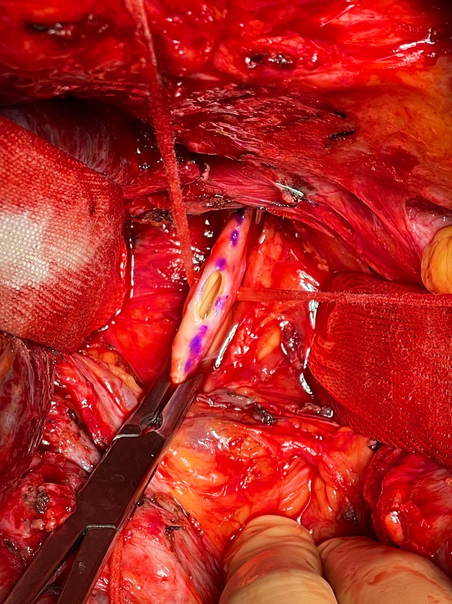 DeCarlis_R's tweet photo. Supraceliac aortic conduit in #liver #transplant @Sa92_10 @MglMichele https://t.co/YToh733ndA