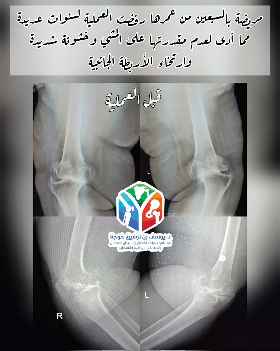 ytkhoja's tweet photo. دائماً ما ننصح مرضى خشونة الركبة بعدم تأخير عملية استبدال المفصل متى ما دعت الحاجة لها لأن تبعات التأخير تؤدي لاستخدام مفاصل معقدة أكثر والنتائج ما بعد العملية تكون أقل نجاحاً

⬇️ نسأل الله أن يجمع لمريضتنا بين الأجر والعافية ⬇️

#فضفضة_طبيب #تغريدة_في_تخصصك #صوت_الطبيب https://t.co/I8NWDKMYZ9