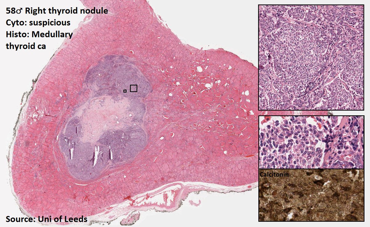 DrTravisBrown's tweet photo. Histology flash card
Medullary thyroid carcinoma
Av 4th-6th decade
75% sporadic
Oft solitary thyroid nodule
At presentation
70% Pts Mets (+ve nodes)
15% dysphagia, hoarseness
Serum calcitonin may correlate➡️ mass
Familial➡️MEN syndrome discussed
Ep 40 #ThisPathLife #podcast https://t.co/9KPRVVj2dN