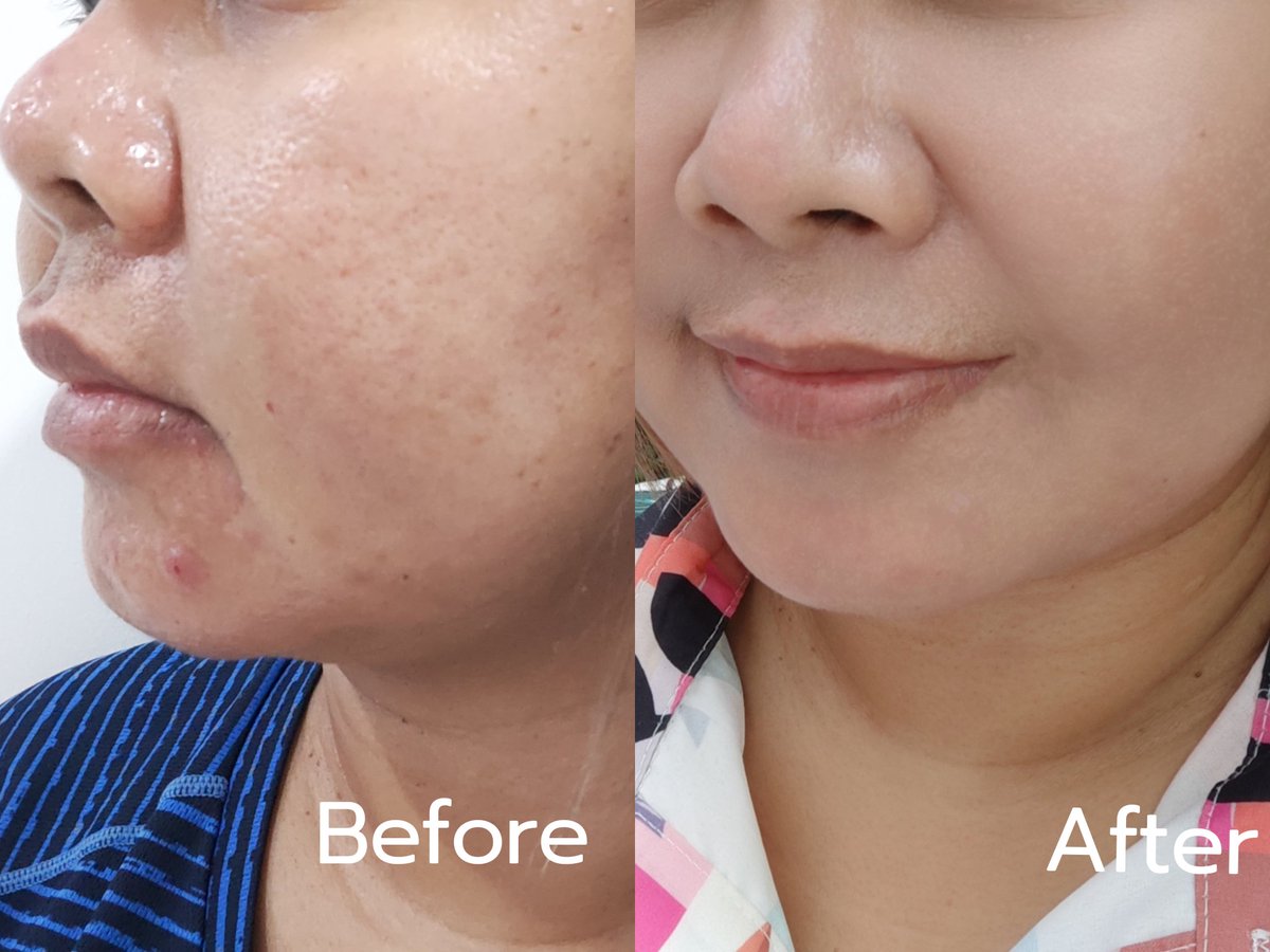 วีคเดียวเริ่ดอยู่นะ 😍 ลองใช้สบู่เห็ดเมลาสม่า เจลเห็ดเมลาสม่าของ smooto หน้าดีขึ้นแบบจึ้งมาก!!😳 รอยสิว กระบางๆ ที่เป็นเกือบเดือนคือจางลง ใช้คู่กันทุกวันจนหน้าดีขึ้นเรื่อยๆ จากที่คิดจะต้องเข้าคลีนิคก็ไม่ต้องละ ตอนนี้ลงแค่แป้งเด็กคือออกจากบ้านได้เลย เริ่ด👍 #ของดีบอกต่อ #ถูกและดี