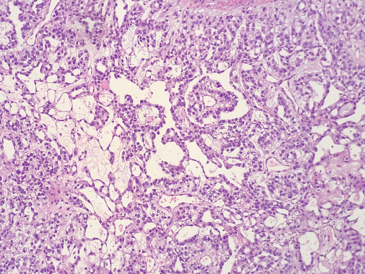 FelipePatologia's tweet photo. Young child with a pre-sacral mass.

What serum marker is more likely to be elevated?

#PathTwitter #pedpath 

@GeronimoJrLapac https://t.co/vZrryNPxiU