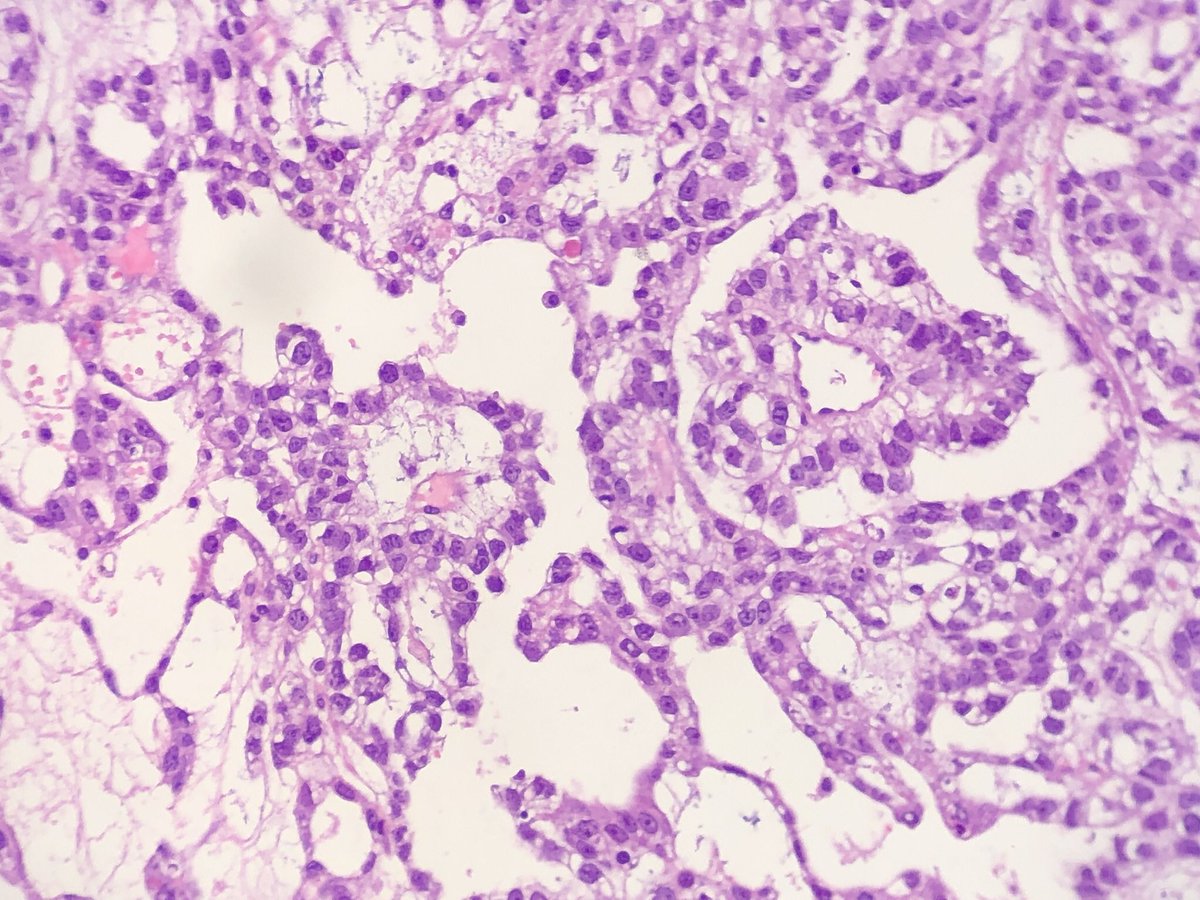 FelipePatologia's tweet photo. Young child with a pre-sacral mass.

What serum marker is more likely to be elevated?

#PathTwitter #pedpath 

@GeronimoJrLapac https://t.co/vZrryNPxiU