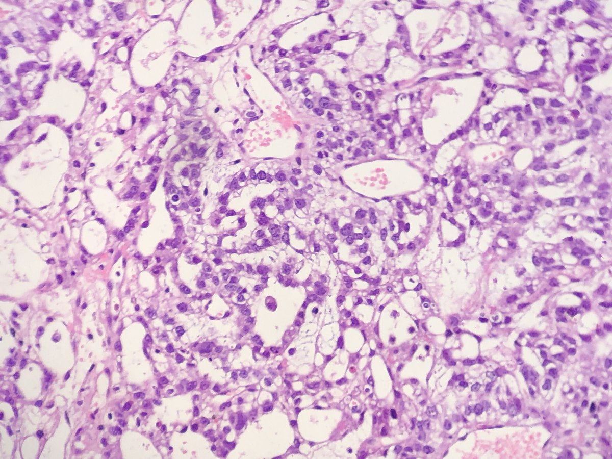 FelipePatologia's tweet photo. Young child with a pre-sacral mass.

What serum marker is more likely to be elevated?

#PathTwitter #pedpath 

@GeronimoJrLapac https://t.co/vZrryNPxiU