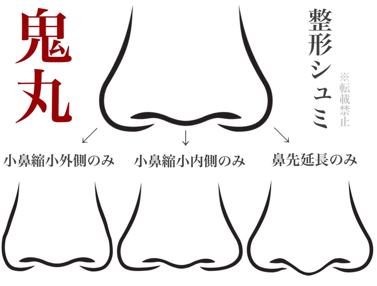 鼻整形の相談所🏥鼻翼縮小、小鼻縮小、鼻尖縮小、鼻尖形成、鼻中隔延長、プロテーゼ、二重整形、目頭切開 on Twitter