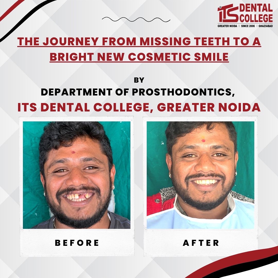 'Journey from missing teeth to a bright new cosmetic smile', by Department of Prosthodontics, ITS Dental College and Research Center, Greater Noida.
.
#ITSDentalCollege #DepartmentOfProsthodontics #Prosthodontics #HappyPatientHappyUs #OralRehabilitation #CompleteDentures #Denture