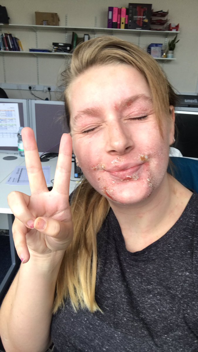 BmilyEanks's tweet photo. Wondering round the hospital in all my scabby glory
🎶 I am what I ammmm 🎶 

#topicalsteroidwithdrawal #tswawareness https://t.co/7O53kTjCKJ
