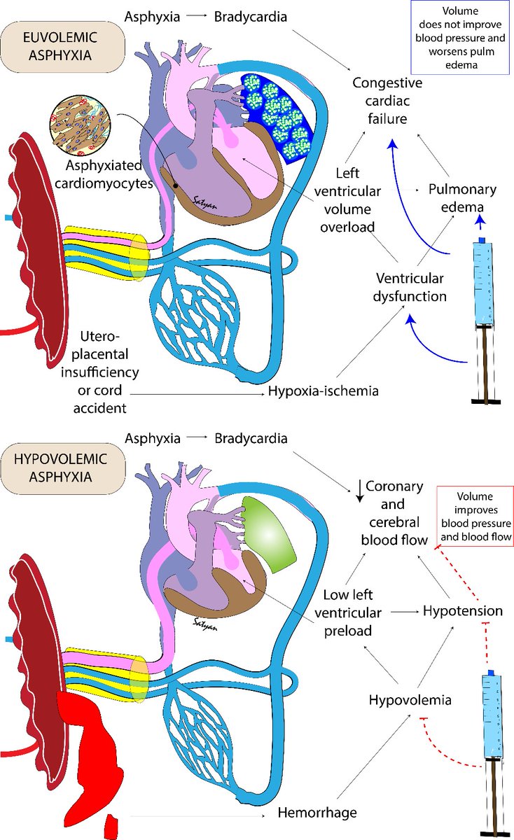 Is there a role for volume replacement during neonatal resuscitation? A review by <a href="/EmilyCALane/">Emily Lane</a> Rebecca Valdez, Amy L. Lesneski and <a href="/neosatyan/">Satyan</a> from <a href="/UCDavisChildren/">UCDavisChildrensHosp</a> mdpi.com/2227-9067/9/10…