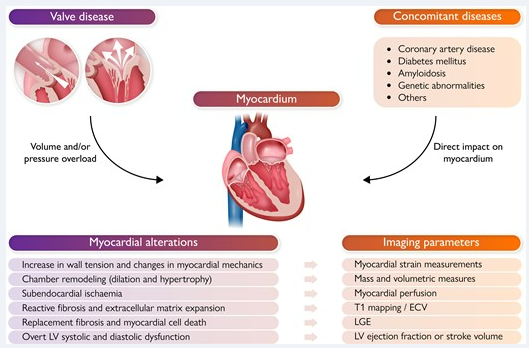 Valvular heart disease: shifting the focus to the myocardium pubmed.ncbi.nlm.nih.gov/36167923/ @NAjmoneMarsan @JoaoLCavalcante @pattypellikka @ehj_ed @SRValveCenter @ValveDisease @crfheart @PhilGenereuxMD @ffortuni @hgermanstrias