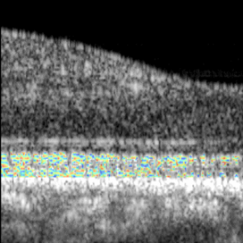 Michael F. Chiang, MD (@neidirector) on Twitter photo Simpler & faster way to complete optoretinograms by measuring the speed at which retinal neurons move relative to each other, using a new #OCT camera.
<a href="/rjonnal/">Ravi Jonnal</a> <a href="/ucdavis/">UC Davis</a> <a href="/ucd_eyecenter/">UC Davis Eye Center</a>
<a href="/OpticaPubsGroup/">Optica Publishing Group</a> paper: bit.ly/3SoGEDg Simpler & faster way to complete optoretinograms by measuring the speed at which retinal neurons move relative to each other, using a new #OCT camera.
<a href="/rjonnal/">Ravi Jonnal</a> <a href="/ucdavis/">UC Davis</a> <a href="/ucd_eyecenter/">UC Davis Eye Center</a>
<a href="/OpticaPubsGroup/">Optica Publishing Group</a> paper: bit.ly/3SoGEDg