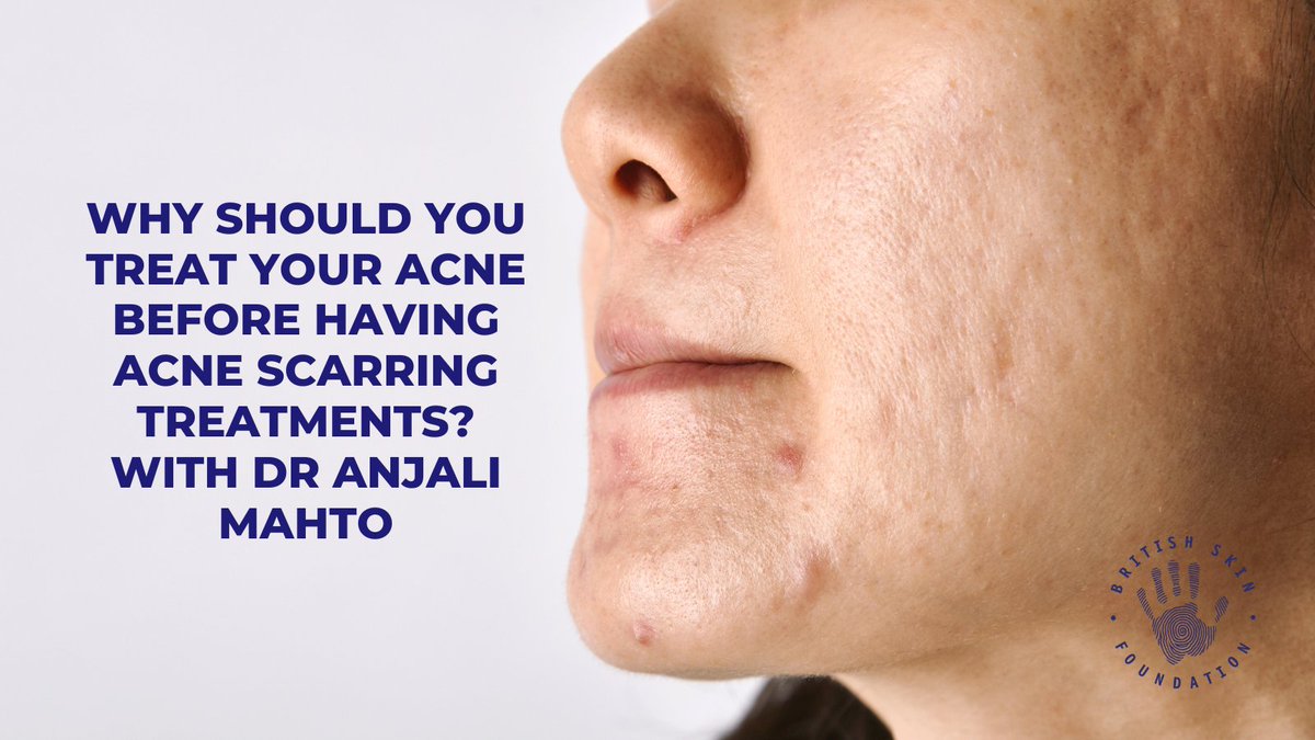 British Skin Foundation (@bsfcharity) on Twitter photo Many people are not only keen to have their acne treated but also the scarring it has left behind. <a href="/DrAnjaliMahto/">Dr Anjali Mahto</a> sat down with the BSF to explain the problem with having acne scarring treatment before your acne has been fully treated. Read more here: buff.ly/3DZhJSK Many people are not only keen to have their acne treated but also the scarring it has left behind. <a href="/DrAnjaliMahto/">Dr Anjali Mahto</a> sat down with the BSF to explain the problem with having acne scarring treatment before your acne has been fully treated. Read more here: buff.ly/3DZhJSK