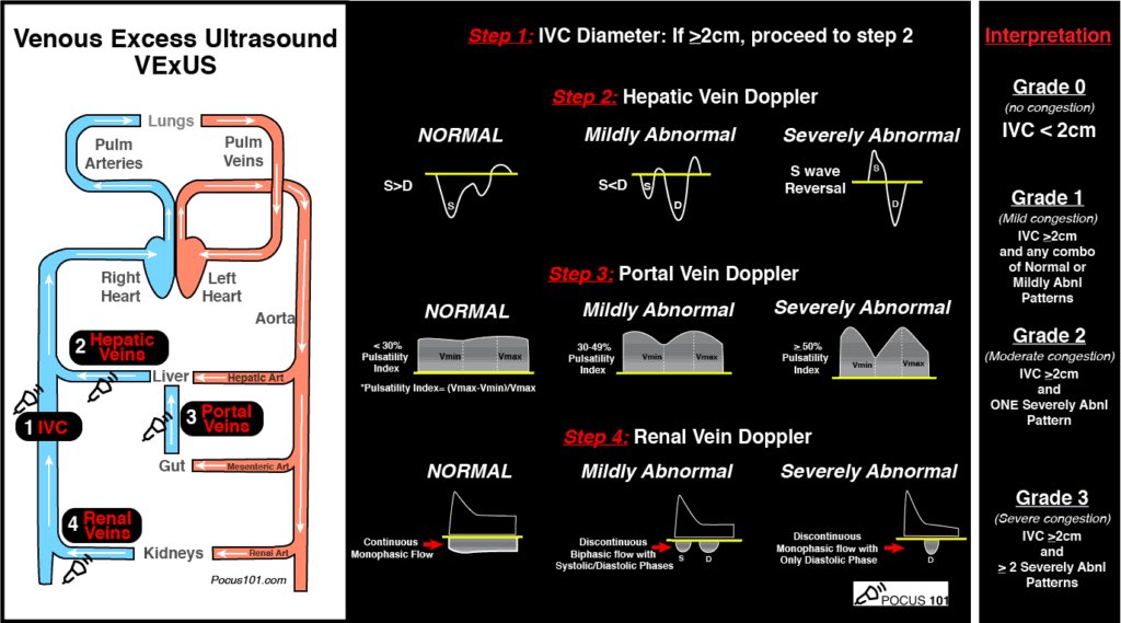 TaotePOCUS's tweet photo. 🔵 Right-sided venous congestion  assessment 

#POCUS  #VExUS https://t.co/X9OStM015z