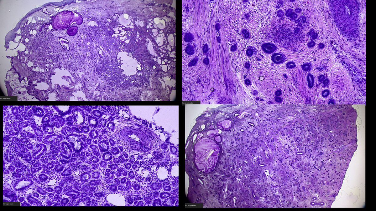 Wednesday frozen section for trainees.  40 YO/F cervical cone.  Tumor everywhere! Margins positive #notsofast.  What’s going on here?
